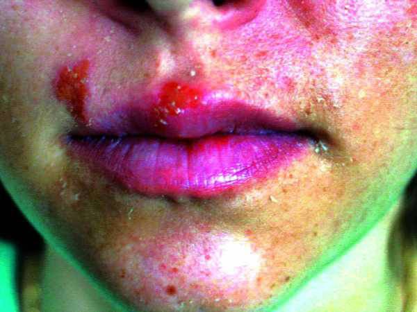 মুখ ও ঠোঁটে ভাইরাস