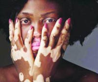 শ্বেতী রোগ