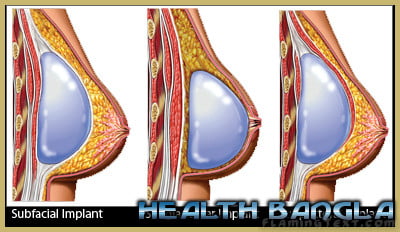 breast augmentation