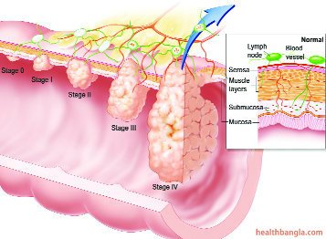 Colorectal Cancer Colorectal Cancer
