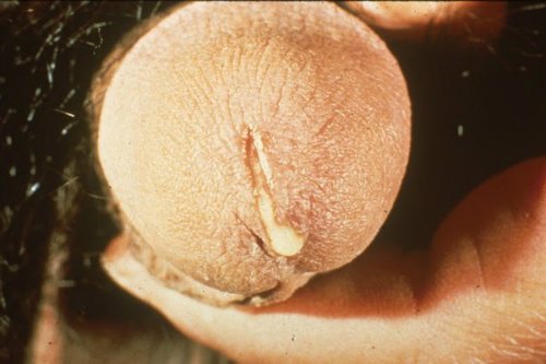 Gonorrhea Symptom