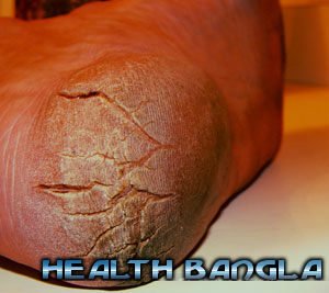 Cracked Heel