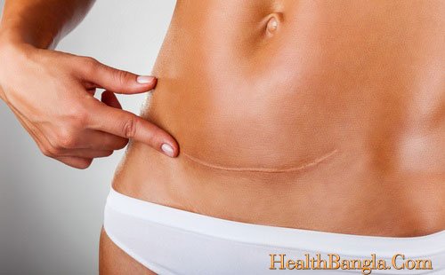 caesarean-operation caesarean-operation