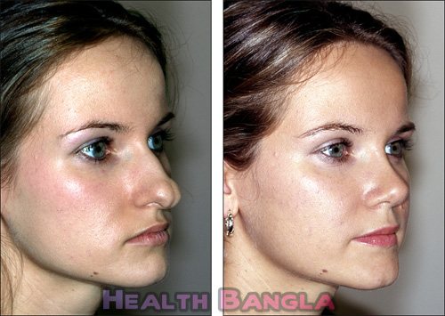 Rhinoplasty-Nose