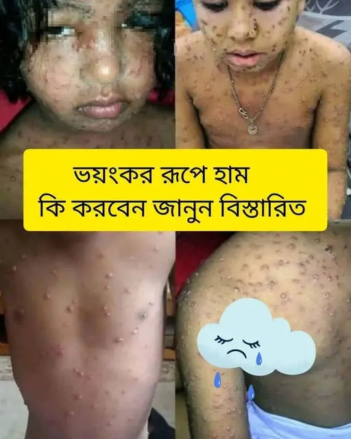 Measles Bangladesh